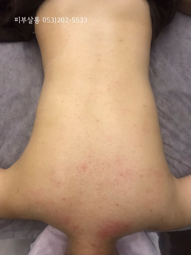 대구피부관리실)달서구 알라딘필링팔여드름자국재생케어리뷰/죽전동피부관리실 10