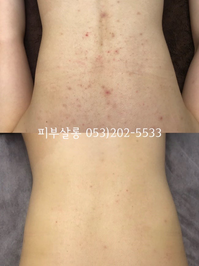 대구피부관리실)달서구 알라딘필링팔여드름자국재생케어리뷰/죽전동피부관리실 11