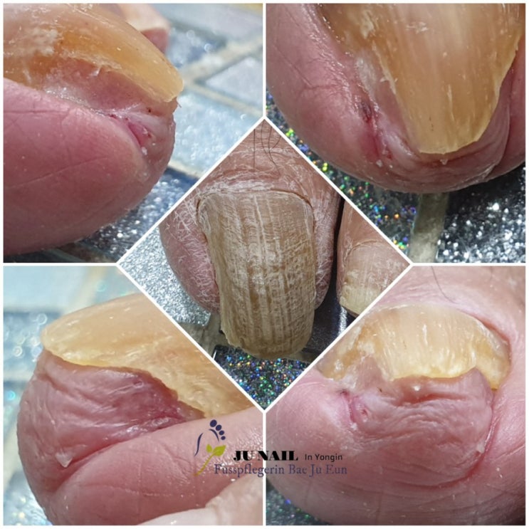 할아버지의 두꺼운 발톱무좀 관리후기/분당용인수원수지보정동백죽전동/주네일/무좀파고드는내향성발톱손톱변형전문네일샵 할아버지의 두꺼운 발톱무좀 관리후기/분당용인수원수지보정동백죽전동/주네일/무좀파고드는내향성발톱손톱변형전문네일샵