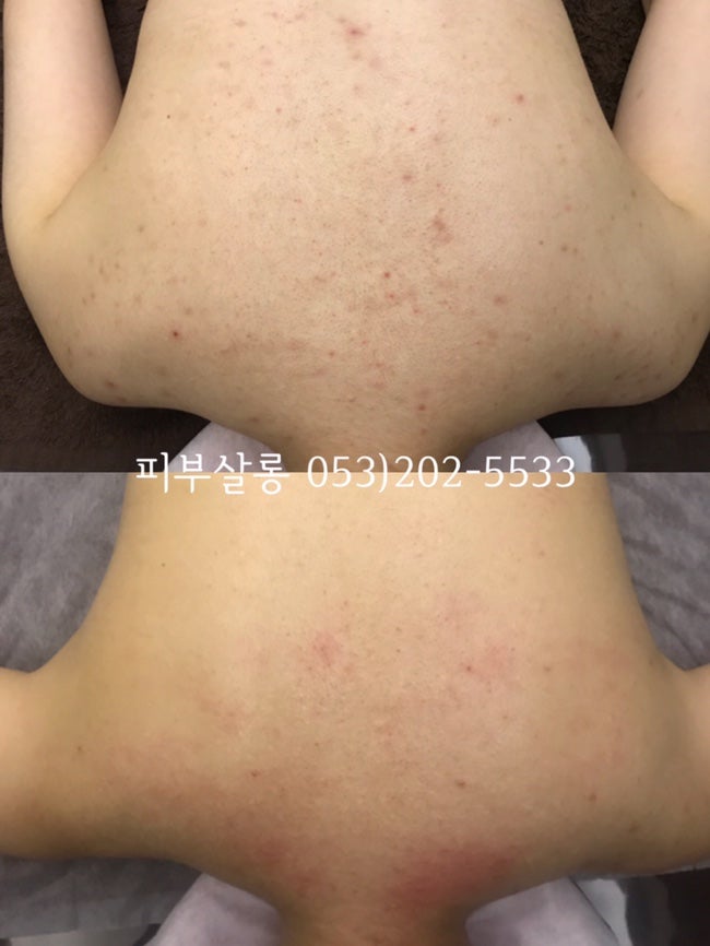 대구피부관리실)달서구 알라딘필링팔여드름자국재생케어리뷰/죽전동피부관리실 7
