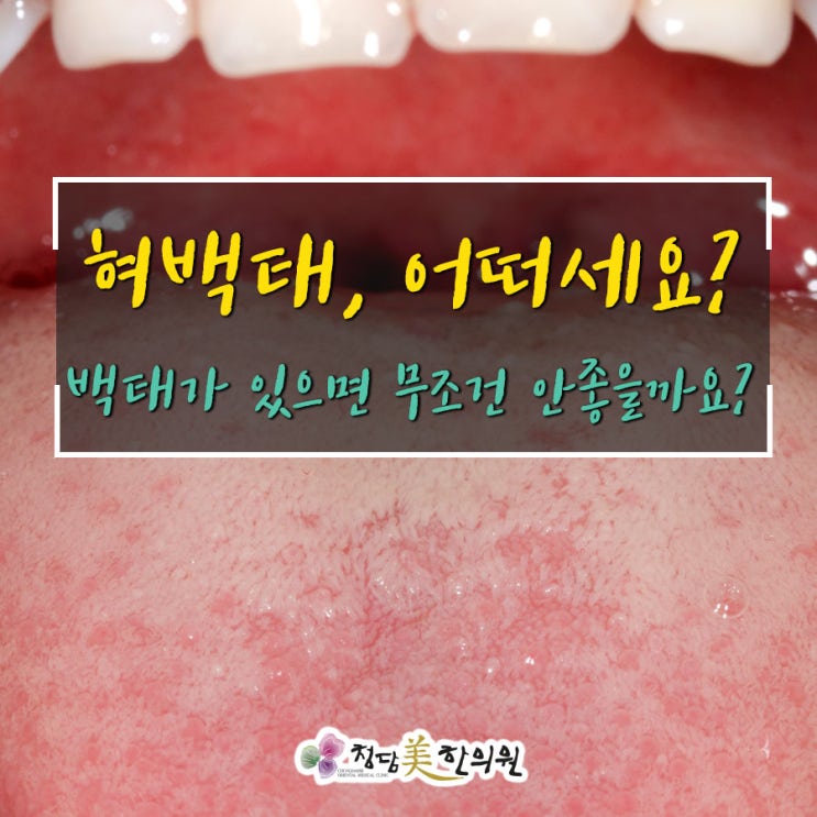 혀 색깔로 보는 건강, 질병 캐내고 건강지키자! 혀 색깔로 보는 건강, 질병 캐내고 건강지키자!