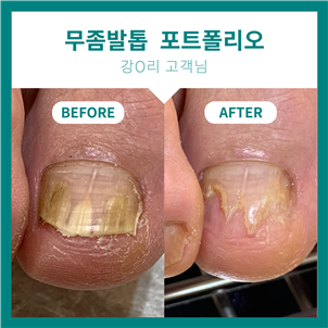 시흥 무좀발톱 관리 전문가에게 받은 후기! [ 페디아이티엔 ]