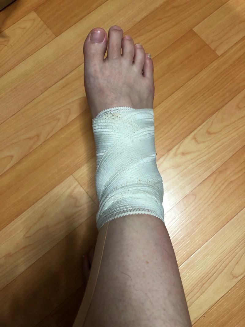 발목부상. 발목 염좌 혹은 건초염인 듯요 : 네이버 블로그, image size:800x1067