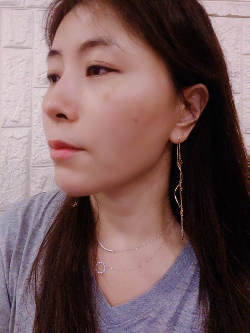 인모드리프팅으로 이중턱, 얼굴살 빼는 법 실천! 멍 일주일 후기 : 네이버 블로그 인모드리프팅으로 이중턱, 얼굴살 빼는 법 실천! 멍 일주일 후기 : 네이버 블로그