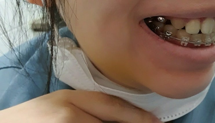  치아교정15) 6.3 월치료 간단후기