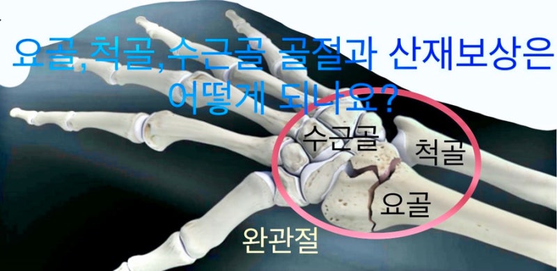 손목골절(요골,척골,완관절 골절)-산재 후유장해 산출(1) : 네이버 블로그