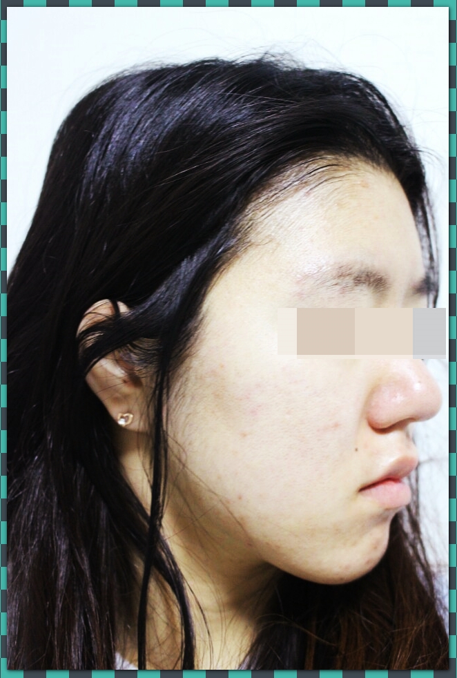  지루성피부염 완치 생각보다 빨리했고 어렵지 않았음