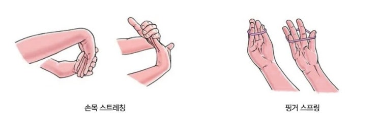  방아쇠수지증후군 (손가락이 구부러진 채 펴지지 않는 증상) / 연세스타병원