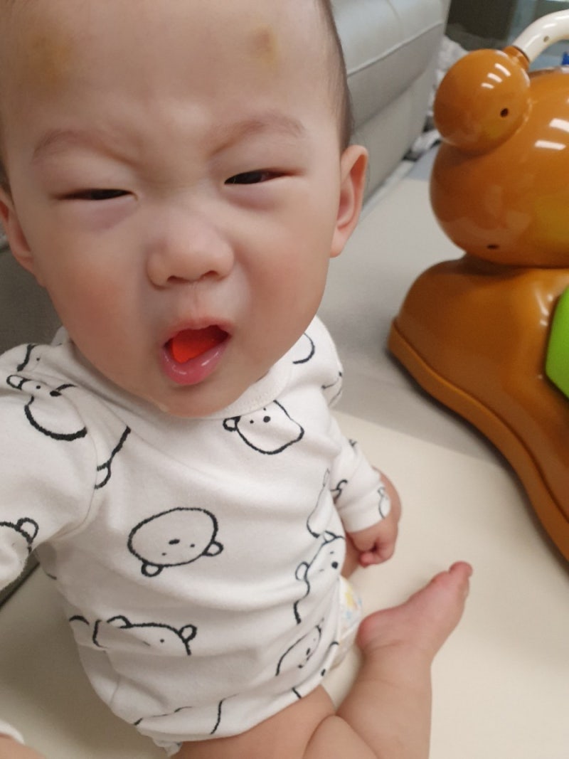 10개월 아기 넘어짐사고(멍크림후기) 8