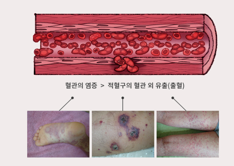 피부혈관염, 혈관염 치료와 스테로이드, 면역억제제