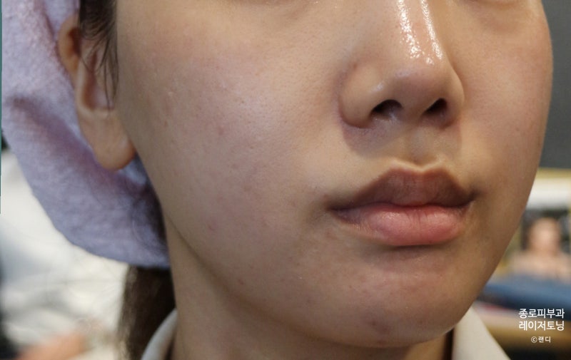 서울 종로피부과 VRM 레이저토닝, 색소침착관리 2차 리뷰 및 경과 2