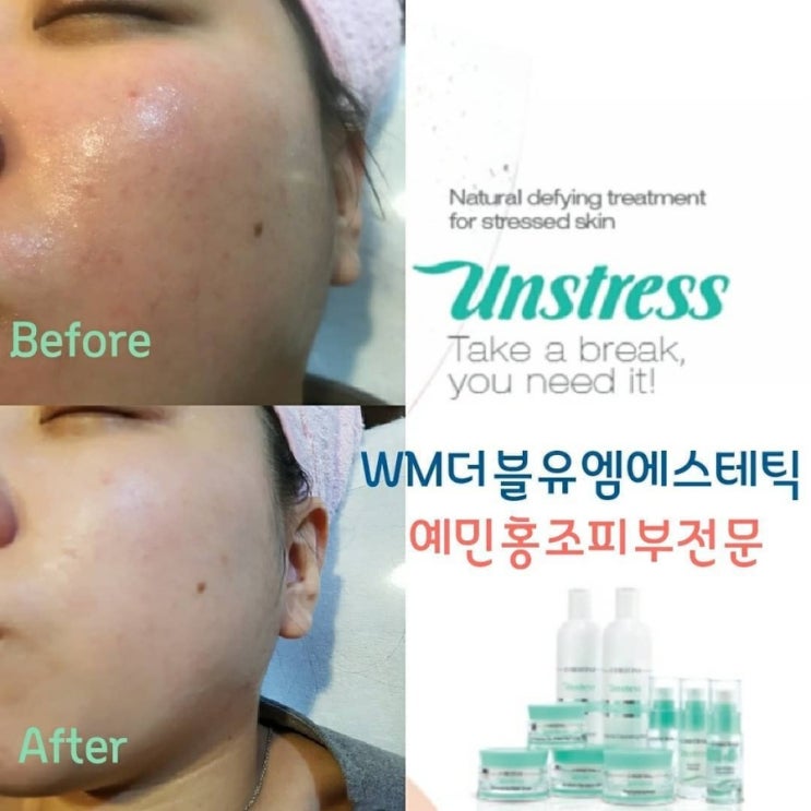  언스트레스피부관리️더블유엠산격점️