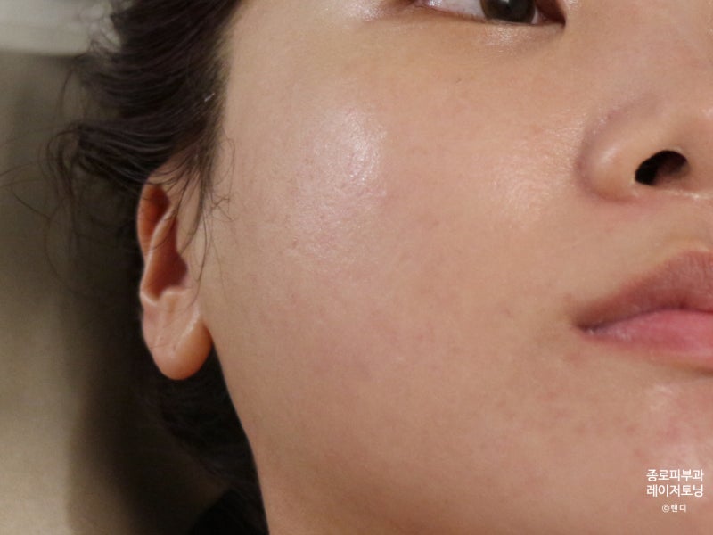 서울 종로피부과 VRM 레이저토닝, 색소침착관리 2차 리뷰 및 경과 4