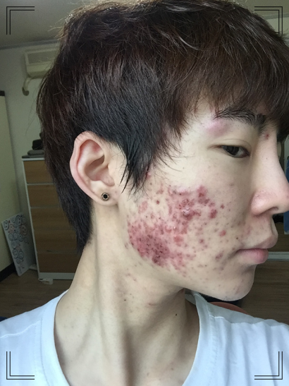  피지조절약 써본 내가 말하는 피지조절제 효과, 부작용