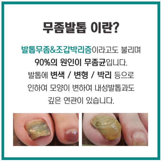 경기도 시흥 냄새나는 무좀발톱! 페디아이티엔후기