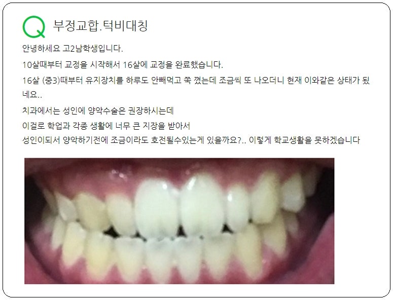 턱 부정교합 교정 중학생도