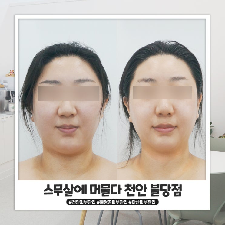 불당동 피부관리 웨딩촬영 전 스무살에 머물다에서 받았어요! 불당동 피부관리 웨딩촬영 전 스무살에 머물다에서 받았어요!
