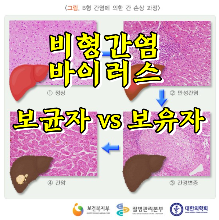  B형간염 항체검사 음성 판정,, 간염 바이러스 보균자 보유자란?