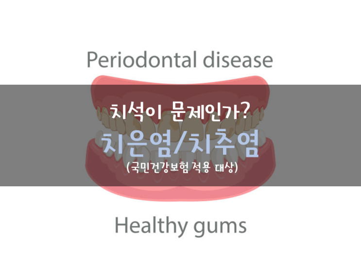 치석(dental calculus) 무엇이 문제인가? 간단하게 알아보는 치은염, 치주염! 그리고 국민건강보험 적용 대상 알아보기