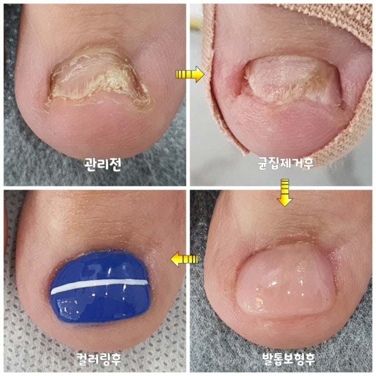 잘못된 발톱관리 무좀발톱 계속 갈아내시면 이렇게 변해요./분당용인수원수지보정동백죽전동/주네일/무좀파고드는내향성발톱손톱변형전문네일샵 잘못된 발톱관리 무좀발톱 계속 갈아내시면 이렇게 변해요./분당용인수원수지보정동백죽전동/주네일/무좀파고드는내향성발톱손톱변형전문네일샵
