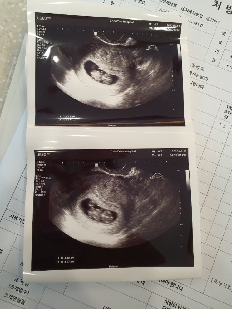 임신 6주, 7주, 9주 증상 / 입덧약 / 심장소리 / 젤리곰 보기 / 난소물혹발견 / 후굴자궁