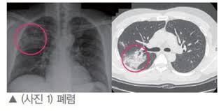  간호학 폐렴 문헌고찰 3편 : 폐렴 간호중재 간호진단 특수치료 케이스