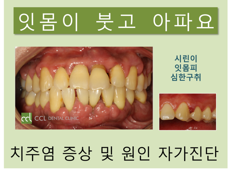 치주염 증상의 원인과 치료 5