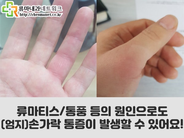 엄지손가락 통증 손가락 관절 부음 2