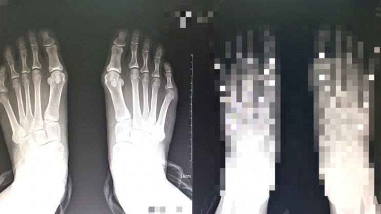  JJ의 오늘 : 무지외반증 소건막류 수술 후기 4일차 (퇴원 전날)