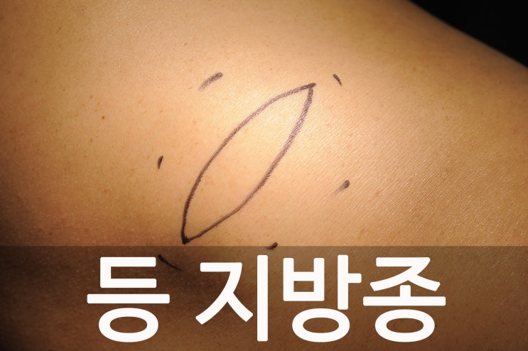  등 지방종 '캡슐로 둘러싸인 거대 지방종 7cm'