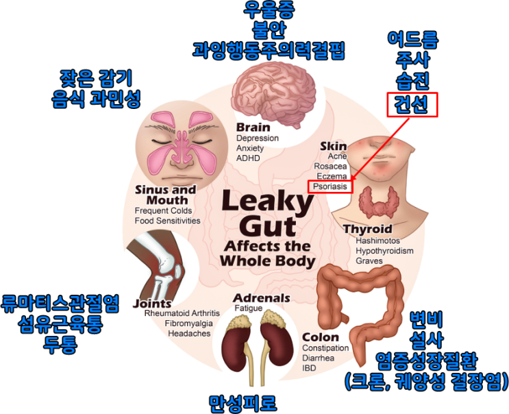 기능의학병원에서는 건선 치료시 어떻게 장누수증후군을 치료하고 있을까???