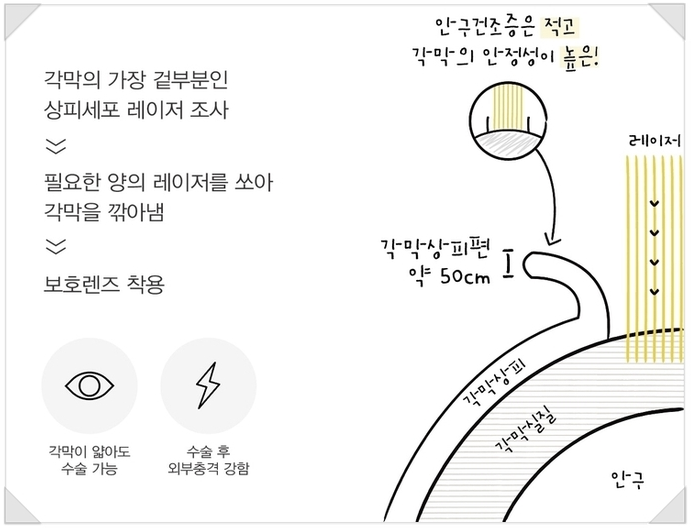 라식, 라섹수술 전! 안전성 확인도