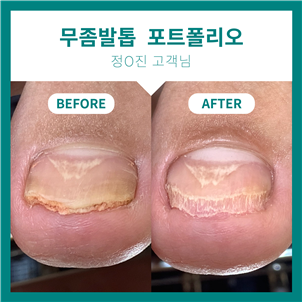 광명 관리하기 힘들고 괴로운 무좀발톱! 페디아이티엔과 관리 시작해요~