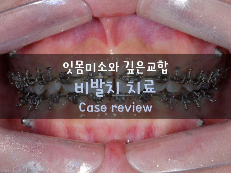 깊은 교합(deepbite;과개교합)과 잇몸미소(gummy smile)를 개선하는 비발치 케이스 리뷰 & 교정시기에 대한 고찰 깊은 교합(deepbite;과개교합)과 잇몸미소(gummy smile)를 개선하는 비발치 케이스 리뷰 & 교정시기에 대한 고찰