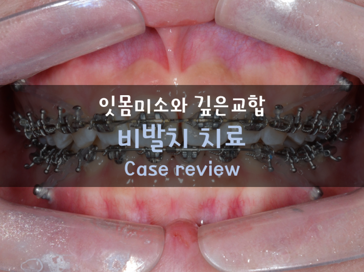 깊은 교합(deepbite;과개교합)과 잇몸미소(gummy smile)를 개선하는 비발치 케이스 리뷰 & 교정시기에 대한 고찰