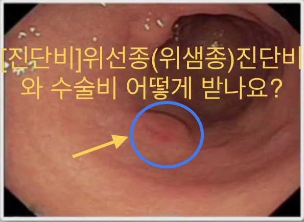  [암보험금] 위선종 진단비와 수술비는 어떻게 받나요?