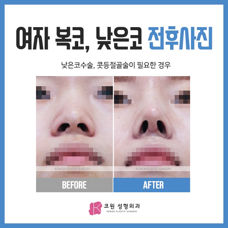 여자복코수술 콧등절골술이 필요한 경우