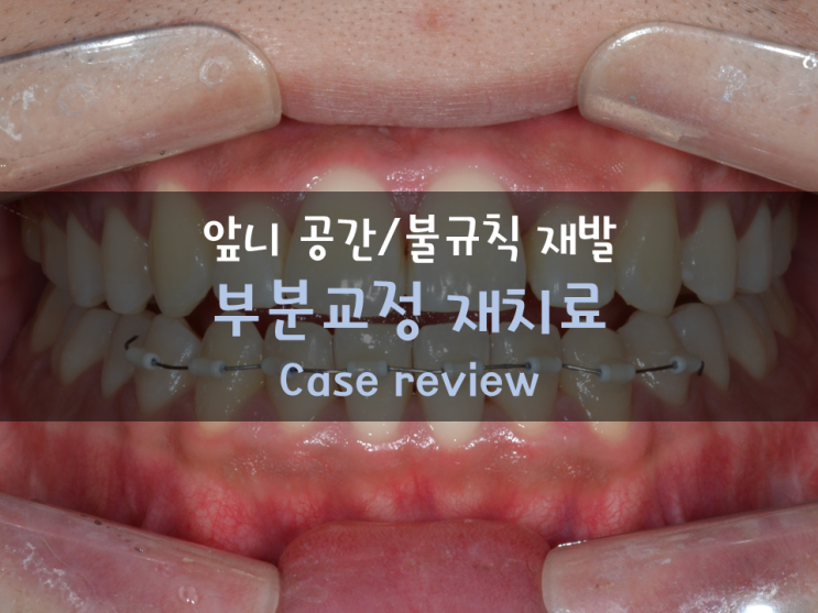 재발된 공간 재교정치료! 유지장치에 대한 고려 & 부분교정으로도 가능한 경우에 대한 고찰! 미사교정치과 재발된 공간 재교정치료! 유지장치에 대한 고려 & 부분교정으로도 가능한 경우에 대한 고찰! 미사교정치과