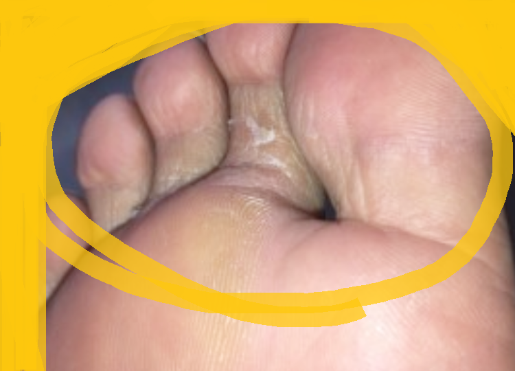 내돈내산 아이나코 눈썹크림 티눈제거 도전 내돈내산 아이나코 눈썹크림 티눈제거 도전