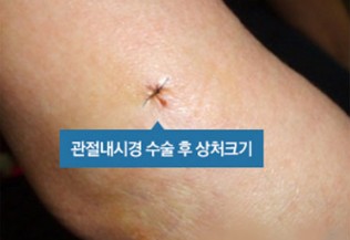  팔꿈치통증(테니스엘보, 골프엘보) 심해질 때! / 연세스타병원(성남 정형외과, 성남 신경외과)