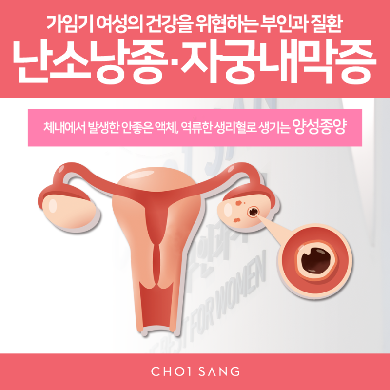 난소낭종 경화술의 단점을 보완하는 치료법은? 7