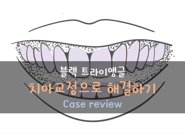 블랙트라이앵글(black triangle) 없애는 교정! (feat. 치간삭제, 치축개선) 교정부작용 없애는 방법