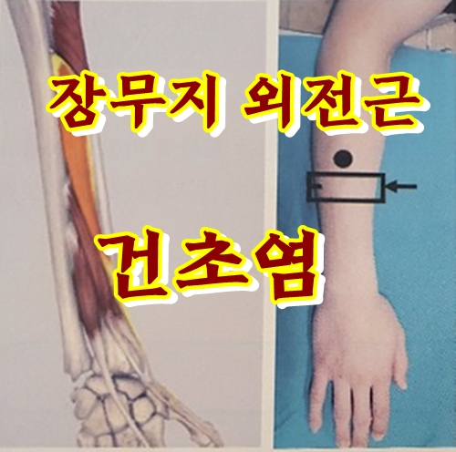  장무지외전근 힘줄 통증(Abductor pollicis longus APL)