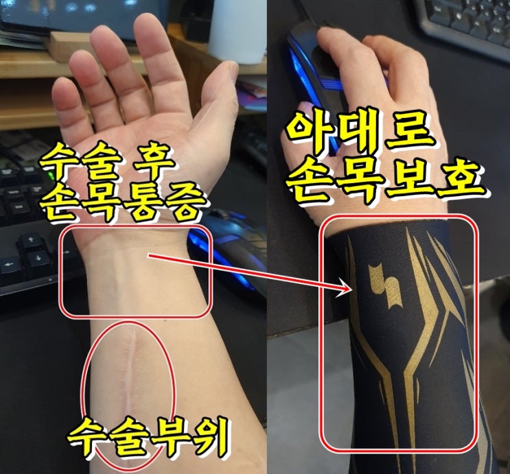  손목터널증후군 통증에 혈자리 마사지 좋네요.