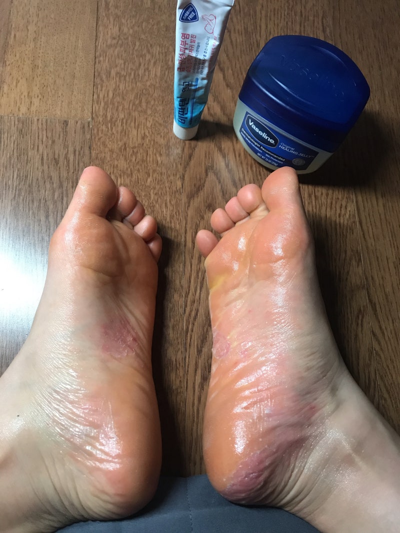 한포진에 비판텐 한 달 이상 바른 후기, 덤으로 화상 스프레이 후기도