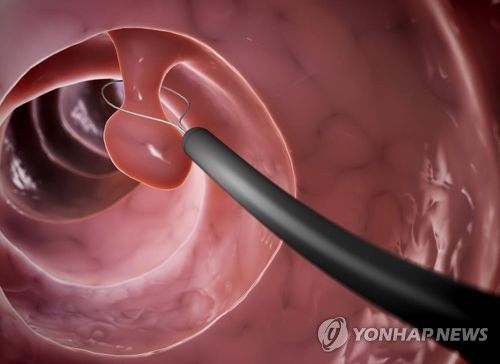 대장 용종도 보장 안되는 4500만원짜리 보험에 뒤통수