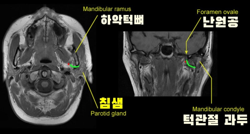 두통 MRI를 찍어야 하나? 뒷목통증 원인과 치료법을 찾고 계시다면 3
