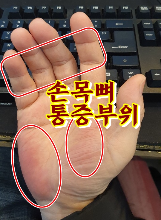  손목뼈 구조, 손목관절염 원인 및 증상