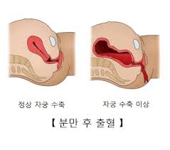  분만 회음절개술 종류 : 장점과 단점 열상관리예방 케겔운동