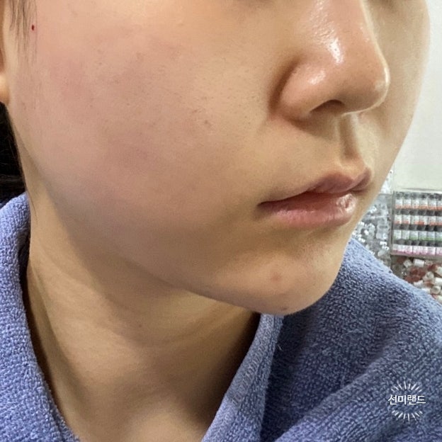 강남 브이씬 윤곽주사 전후 턱보톡스 3